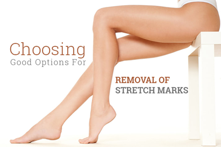 Options For Removal of Stretch Marks